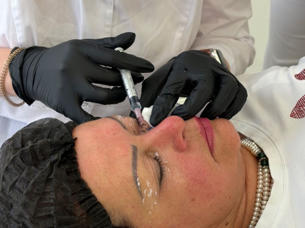 Почему косметологам важно учиться контурной пластике носослезной борозды?