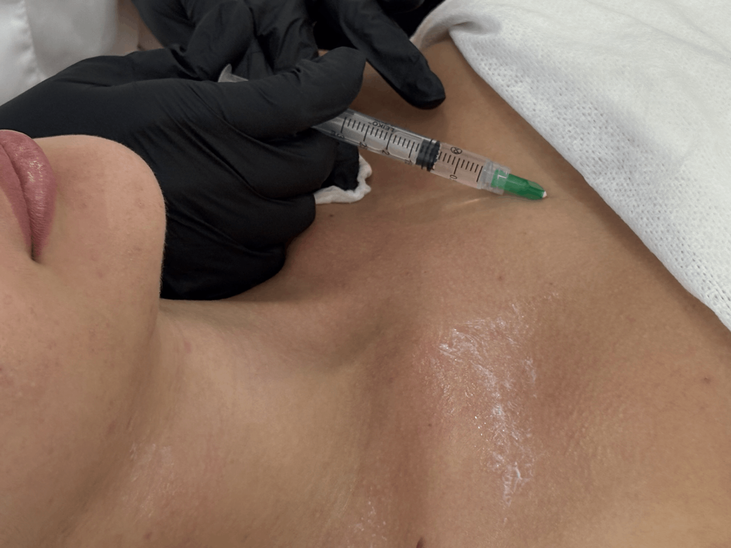 Процедура мезотерапии